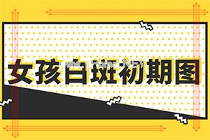 白癞风好治疗[正确治疗方法是]哪家医院能治疗儿童白斑