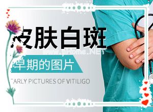 白殿风长在脸上好治吗[带来什么好治]白癞疯能治好吗