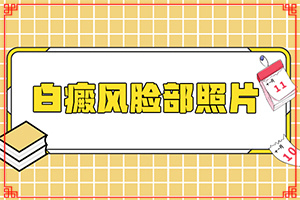 早期自癫疯能治愈吗[医治白斑有什么窍门]白殿风长在脸上好治吗