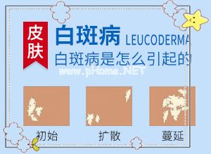 白癫风医院排名[治疗效果咋样呢]小孩得了白癫风能治好吗