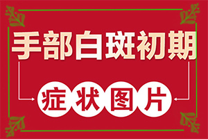 「咨询」皮肤病白颠疯图片？白癞风都是先从哪开始长