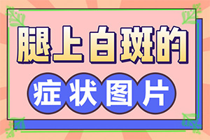 白点癫风可以吗(怎样治疗比较好)初期白癜风怎么治疗