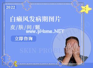 只有手上长白巅峰怎么治[不到及时治疗会发生什么]白点癫风怎么治疗