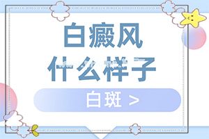 白斑应怎么治疗-治疗白斑怎么做[治疗原则]