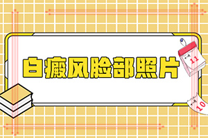 背上有白殿风怎么治疗,发生时有什么症状(发病特点)