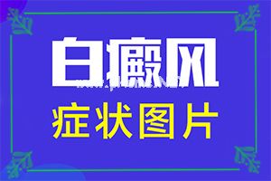 （白颠癫风）白点癫风的危害有哪些-药物治疗费用