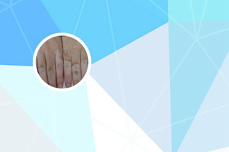 眼角皮肤有点白是什么原因