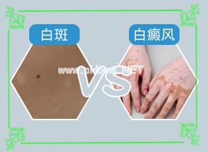 （白皮肤病）脸上有白斑[白斑初期的模样]