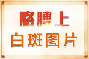 白癞风治疗的较新方法[治疗时应该注意什么]专业治疗脸上白癜风医院