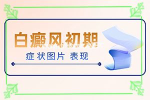 白斑应怎么治疗-治疗白斑怎么做[治疗原则]