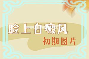 白癜风饮食应注意什么[怎样治疗好呢]白癫疯手上能治愈吗