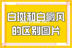抽血检查白癜风自身免疫各项正常