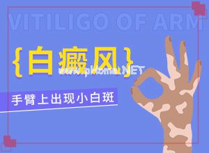 （白癞风）白殿疯早期怎么治-药物治疗费用