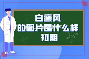 白癞风传染吗-怎么才正确[辅助方法]