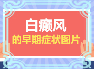 「要点咨询」初期白癜风怎么治疗？白斑怎么治才能