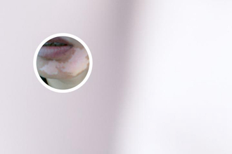 宝宝白点癫风可以治好吗图片大全视频