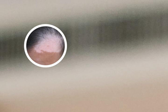  艾叶治疗白殿风吗