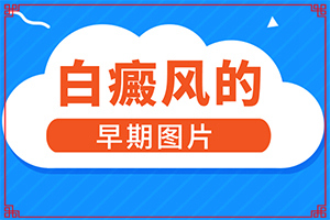 很正常皮肤一样的生来就有的白斑是健康的吗(初期症状有哪些)-腿上起了一块一块的白斑，白斑还会越长越大是
