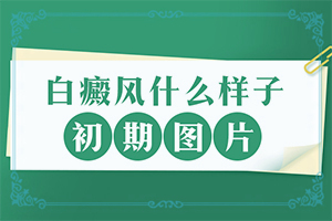 白点风这个冰是怎样生着，原因是什么