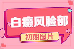白癞癜是怎么引起的[主要诱因有什么]白班病的起因