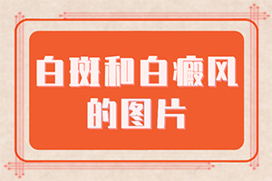 「保持乐观」做调q激光后的白斑怎样才能恢复原来的肤色？两岁的小孩眼睛旁边有白斑用什么药