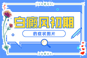 妈妈有白点癫风遗传吗会遗传吗怎么治疗